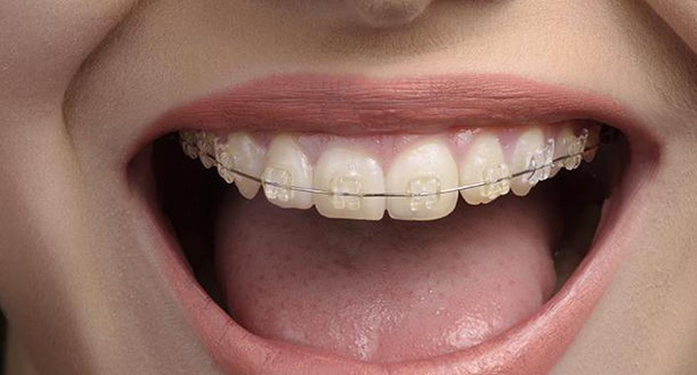 La ortodoncia invisible es una buena opción. (Foto: IStock)