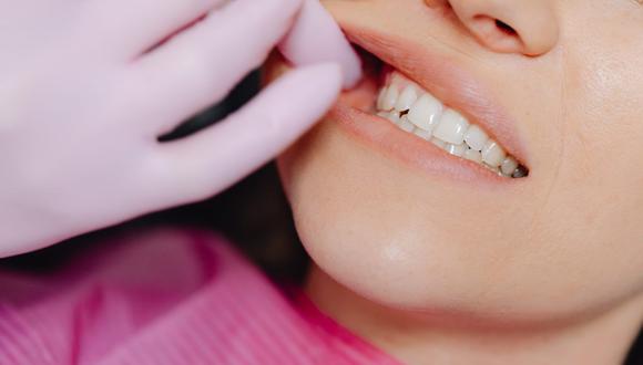 Los dientes flojos o bultos dentro de la boca son señales de alerta frente a este tipo de cáncer. (Foto: Karolina Grabowska / Pexels)