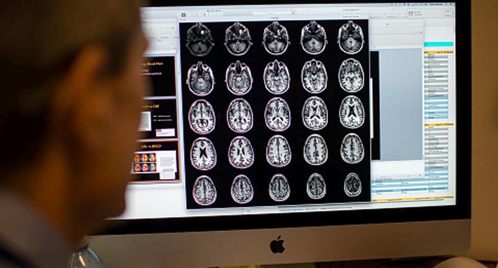 Los genes de la esquizofrenia protegen del Alzheimer con pronóstico más grave, que es el que va acompañado de síntomas psicóticos, según un estudio. (Foto: Getty Images)