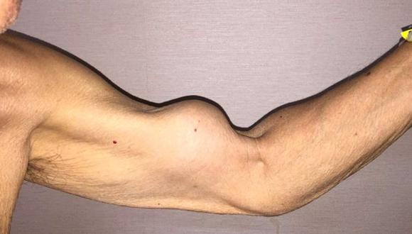 El signo de Popeye te deja sin fuerza por una ruptura total o parcial del tendón que une brazo y hombro. (Foto: New England Journal of Medicine)