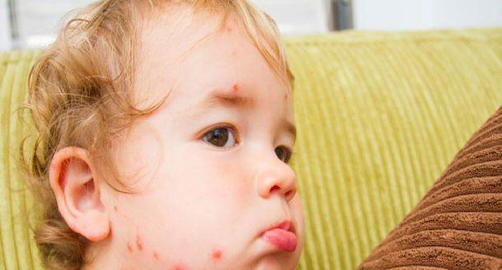 Los niños son los más propensos a sufrir varicela. (Foto: GettyImages)