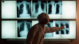 Aumentan los casos de tuberculosis resistente a fármacos