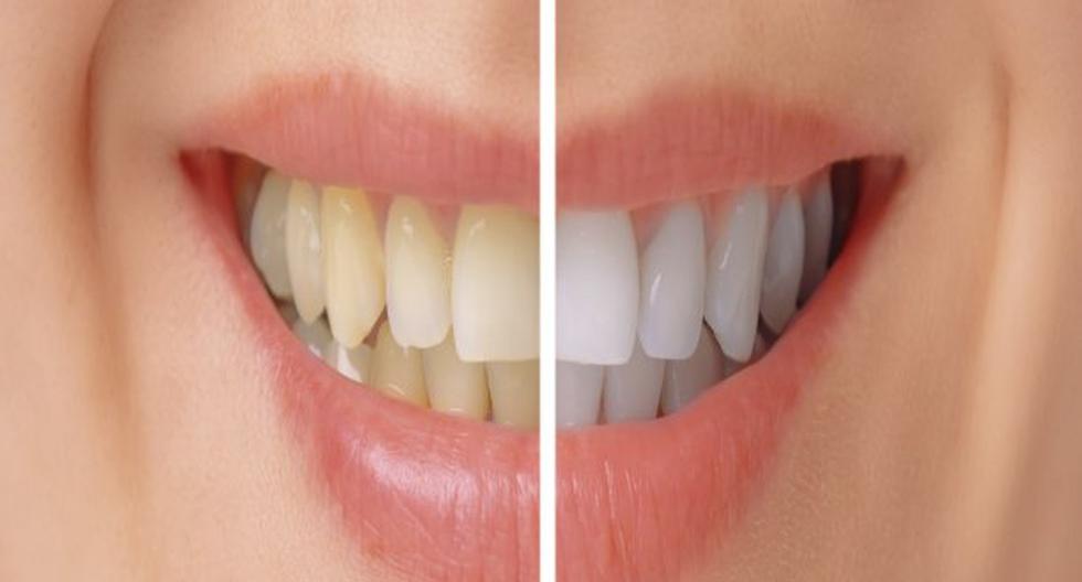 Entérate qué causa los dientes amarillos y cómo puedes blanquearlos. (Foto: ThinkStock)