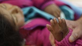 La solidaridad puede curar las manos de pacientes sin recursos en Bolivia [FOTOS]