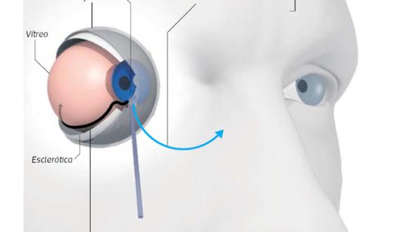 La nueva técnica e instrumental patentados por el oftalmólogo peruano Rodolfo Pérez Grossmann prometen un mejor tratamiento del glaucoma. (El Comercio)