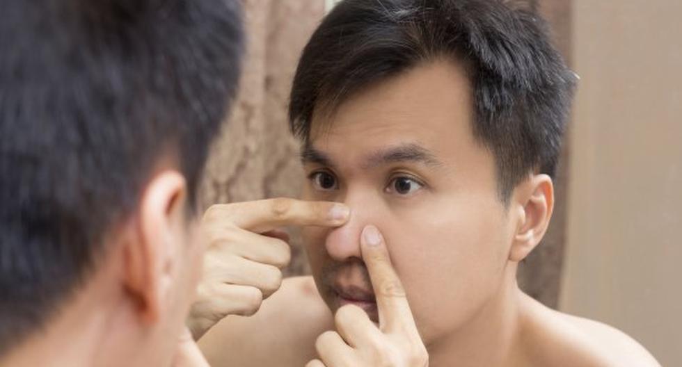 El acné es un problema que afecta a todos. (Foto: ThinkStock)