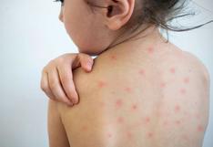 Cuatro de cada diez niños están desprotegidos contra el sarampión: ¿qué pasa con el esquema de vacunación?