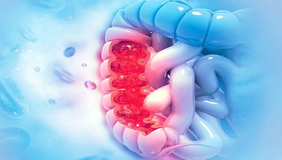 Cáncer de colon: qué células provocan muertes por metástasis