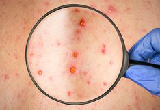 Varicela y sarampión: guía para diferenciar estas enfermedades que brotan en la piel