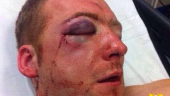 Jugador de rugby deja el deporte tras sufrir terrible asalto