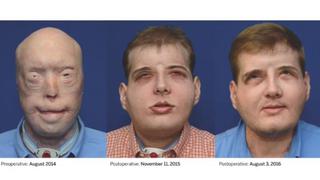 La increíble evolución del rostro de Patrick Hardison [FOTOS]