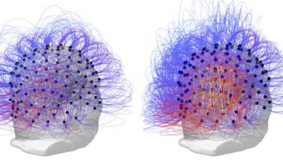 Estos dos escáneres muestran la actividad cerebral del paciente en estado vegetativo antes (izquierda) y después (derecha) del tratamiento.