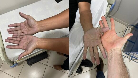Un joven tenía coloración azulada en sus manos y quedó sorprendido con el diagnóstico que recibió. (Foto: Twitter/Ale Ginzo_MD).