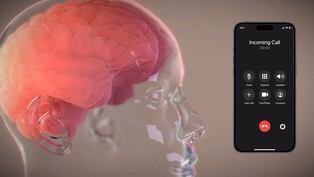 Neuralink implanta chip que permite manejar el celular con la mente