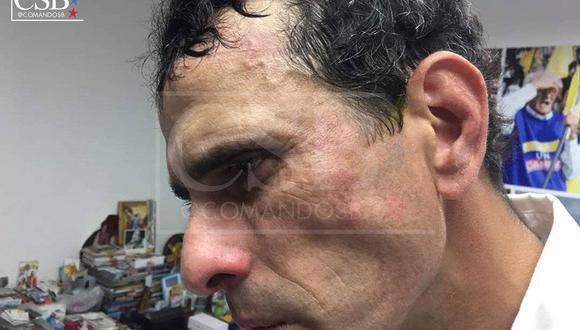 El equipo de campaña de Henrique Capriles divulgó fotos que muestran los golpes que recibió el opositor en el rostro.