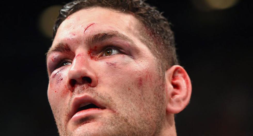 Chris Weidman sufre lesión y queda fuera para el evento estelar de UFC 199 | Foto: UFC