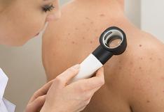 Cáncer de piel: realizarán despistajes gratuitos para prevenirlo