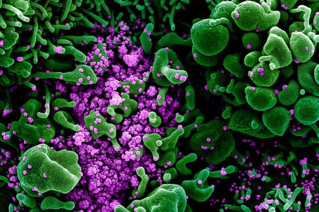 Imágenes de partículas del coronavirus sobre una célula humana, tomadas con un microscopio electrónico y coloreadas en forma artificial. (Foto: National Institute of Allergy and Infectious Diseases [NIAID])