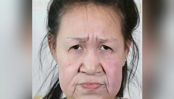 Xiaofeng tiene 15 años y sufre de progeria, una enfermedad genética que le da la apariencia de una mujer de 60 años. (Foto: Shenyang Sunline Plastic Surgery Hospital)