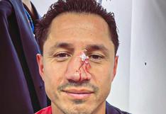 Lapadula volvió a ser operado de la nariz tras fuerte golpe que sufrió en el Cagliari vs. Sassuolo