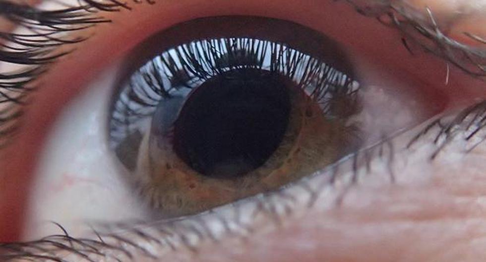 El glaucoma puede causar ceguera. (Foto: Pixabay)