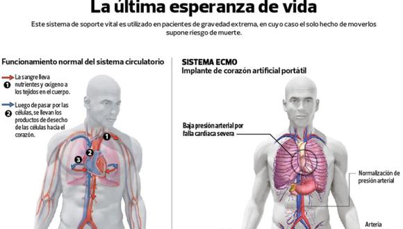 Nuevo corazón artificial móvil estabiliza a pacientes críticos