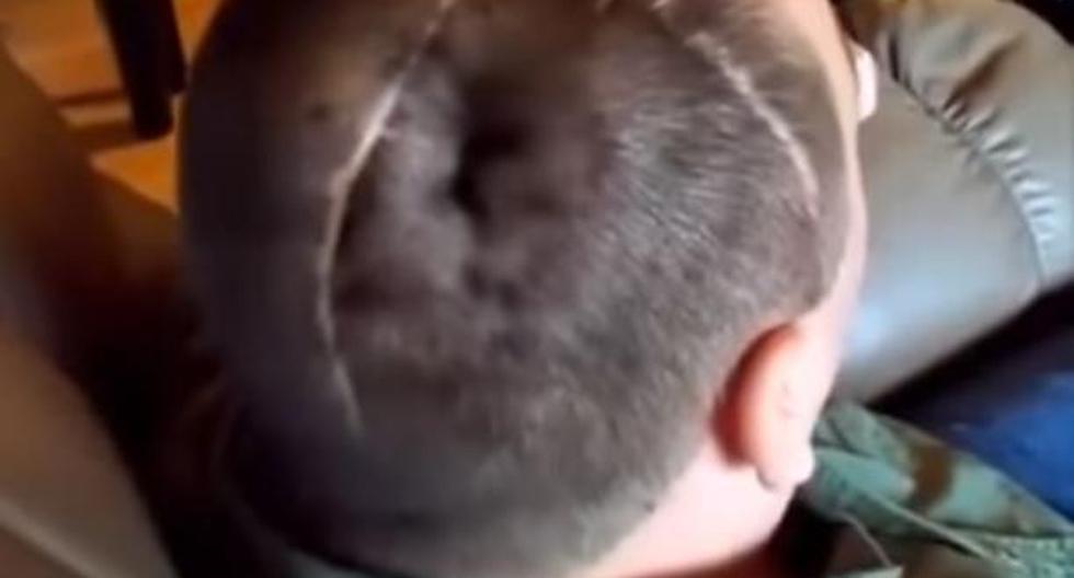 Hombre infla su cráneo al colocar el puño de la boca en la boca y sopla fuerte | Foto: captura/YouTube
