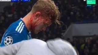 Juventus vs. Lyon: De Ligt quedó con la cabeza sangrando tras chocar con un rival | VIDEO