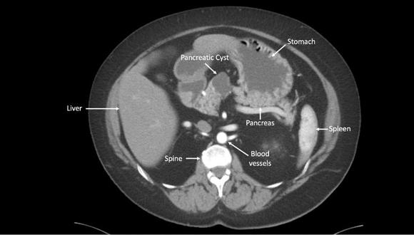 La imagen muestra un quiste pancreático analizado con inteligencia artificial. (Foto: Johns Hopkins Kimmel Cancer Center)