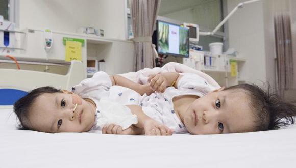 Cirujanos en Australia comenzaron a separar a los gemelos unidos de Bután en una operación delicada. Se espera que dure la mayor parte del día. (Foto: AP)