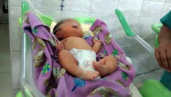 Chimbote: un bebe nació con dos narices y necesita ayuda