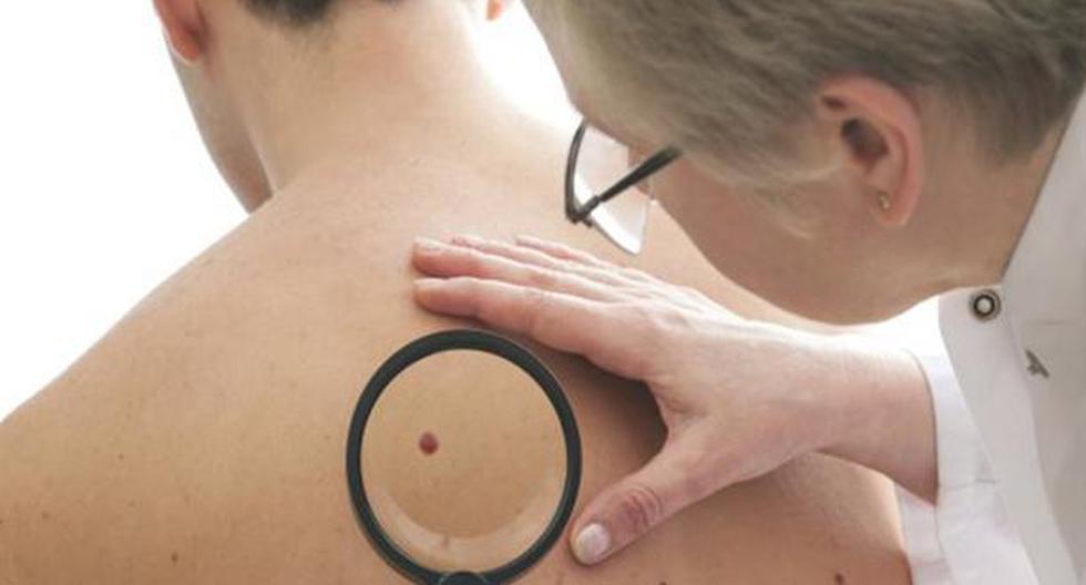 El cáncer de piel se produce por exponerse mucho al sol. (Foto: ThinkStock)