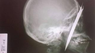 Pasco: mujer que fue acuchillada en la cabeza perdió el ojo