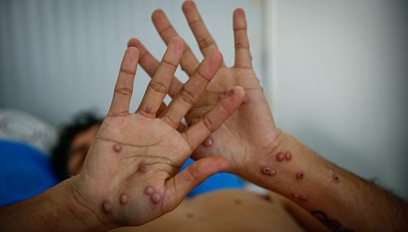Paciente contagiado de Viruela del Mono . Foto/ Hugo Curotto   @photo.gec.