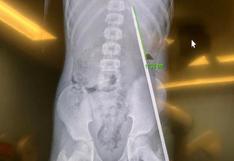 Tarapoto: médicos salvan a menor que fue atravesado en el estómago por un arpón