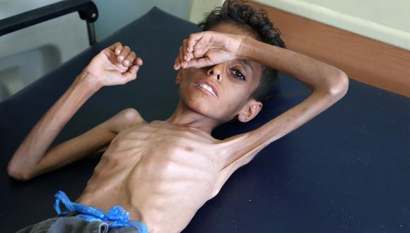 Ghazi Ali bin Ali, de 10 años, sufre de desnutrición severa y yace en una cama de un hospital en Jabal Habashi, en las afueras de la ciudad de Taiz. (AFP / Ahmad AL-BASHA).