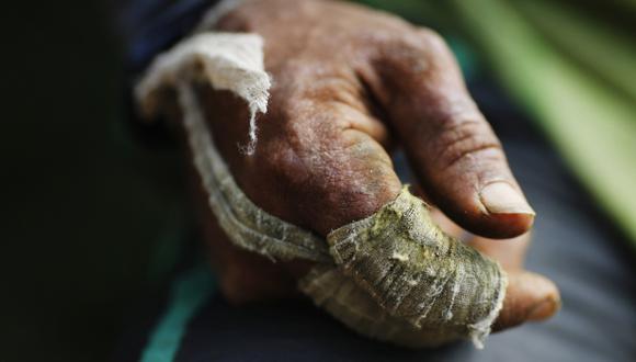 Crean gel de coca que alivia dolores de chikungunya