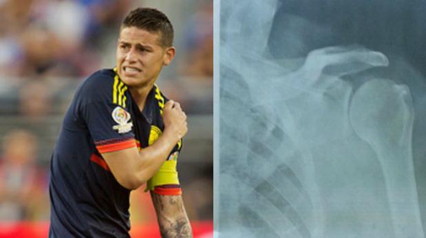James Rodríguez: su lesión en el hombro preocupa a Colombia - 1