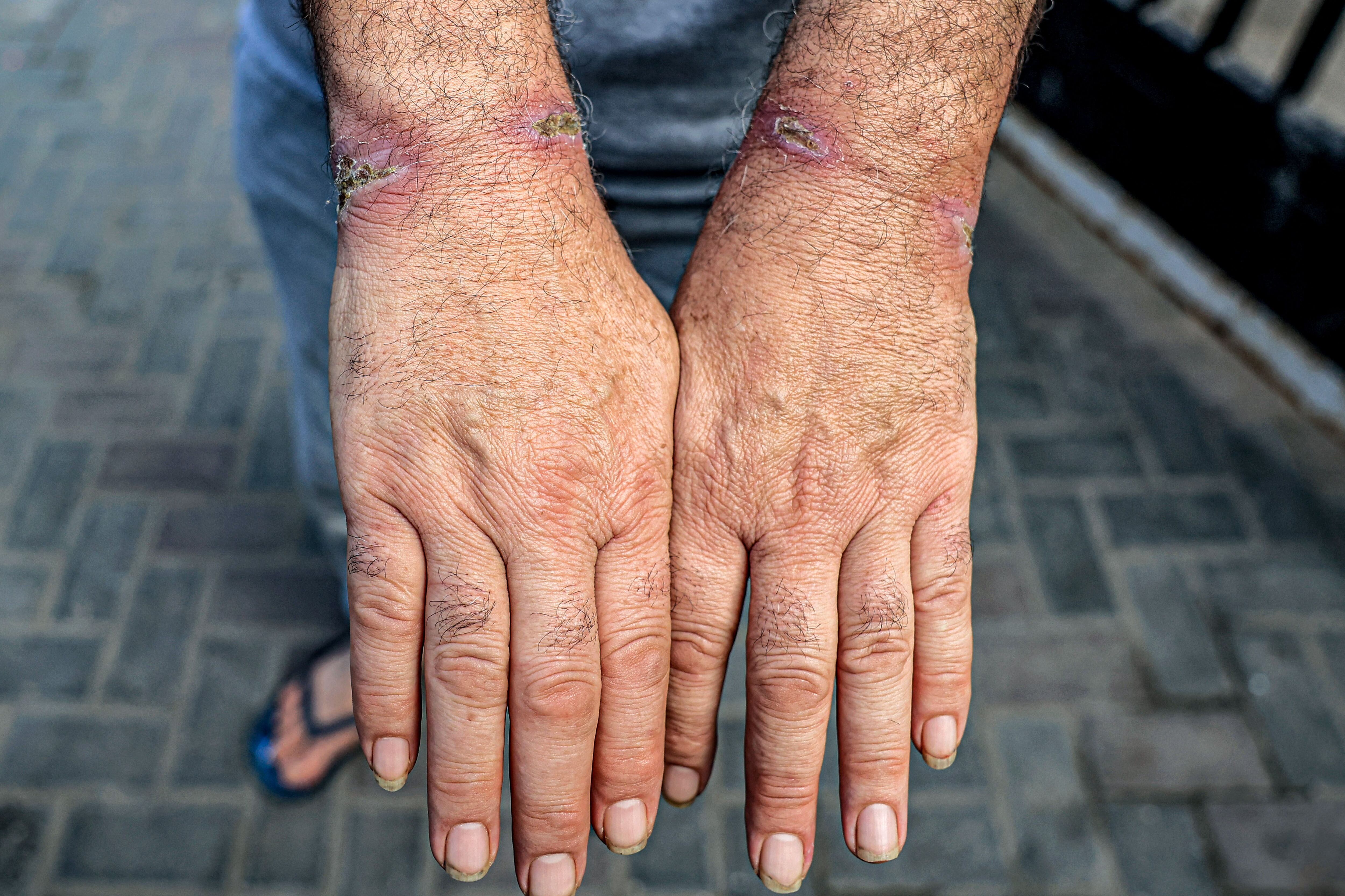 A man who was detained along with other Palestinians by the Israeli army during its operation in the north of the Gaza Strip and later released suffers injuries to his wrists at al-Najjar hospital in Rafah, south of the Gaza Strip.  (Photo by SAID KHATIB/AFP).