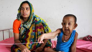 Someten a "Benjamin Button" de Bangladesh a exámenes médicos