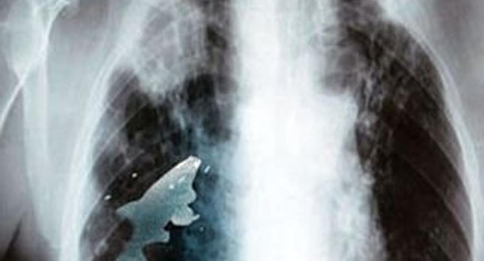 Radiografía que muestra la presencia del pez en el pulmón del niño. (Foto: Agencias)