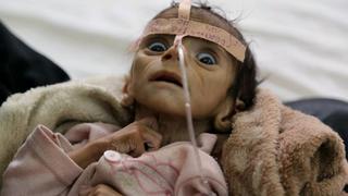 El bebé que murió de hambre a los 5 meses en Yemen