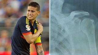 James Rodríguez: su lesión en el hombro preocupa a Colombia