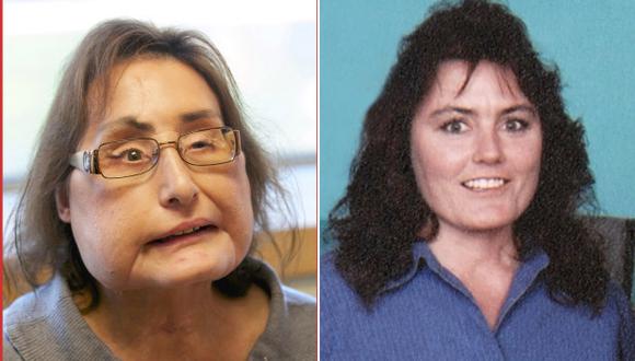Connie Culp, la primera receptora de un trasplante facial parcial en Estados Unidos, murió a los 57 años. (Foto AP / Jason Miller).