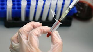 Cuba: detectan cepa de VIH que se desarrolla con mayor rapidez