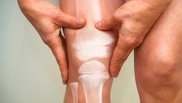La artrosis puede causar desde dolores leves hasta muy intensos, de acuerdo al estadio de la afección y de la deformación de la articulación comprometida. (Foto: Getty Images)