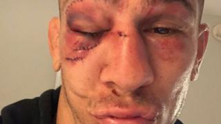 Niko Price aseguró estar “bien” tras perder en el UFC 249, pero su rostro dice lo contrario