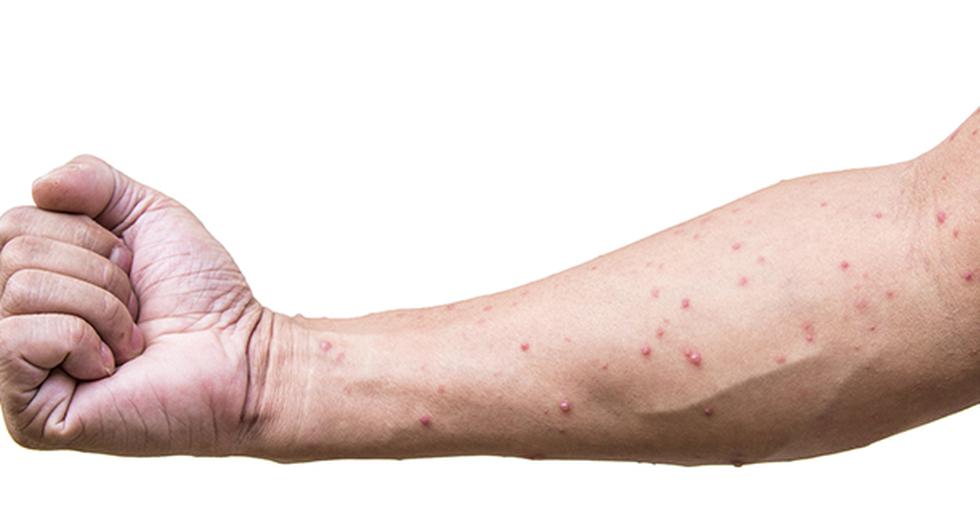 La varicela es una enfermedad muy peligrosa en adultos. (Foto: IStock)