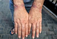 Los palestinos detenidos que están siendo sometidos a amputaciones “de rutina” por lesiones de esposas