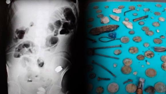 Monedas, pilas, clavos y muchas cosas más fueron encontradas en el estómago de un hombre en Turquía. | Composición: Flashnews / RRSS